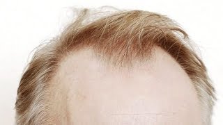 Top 10 Hairstyles for Balding Men Ideas [upl. by Meit688]