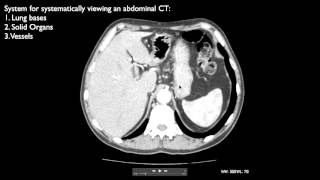 How to interpret an abdominal CT [upl. by Ydnis931]