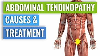 Abdominal Tendinopathy  Causes and Treatment Including Exercises [upl. by Eardnaed520]