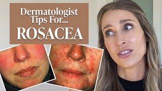 Dermatologist’s Guide to Rosacea What Is It Dos amp Don’ts Treatment Tips amp More  Dr Sam Ellis [upl. by Waltner409]