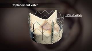 TAVI Transcatheter Aortic Valve Implantation [upl. by Alilak]