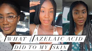 WHAT USING AZELAIC ACID DID TO MY SKIN [upl. by Alliuqat]