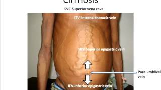 Interpreting abdominal wall veins [upl. by Beeson731]